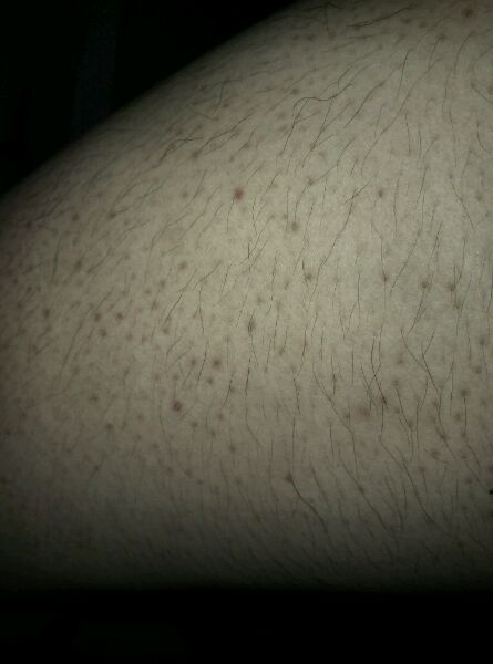 遇到鸡皮肤时应该怎么应对是否能够根治？